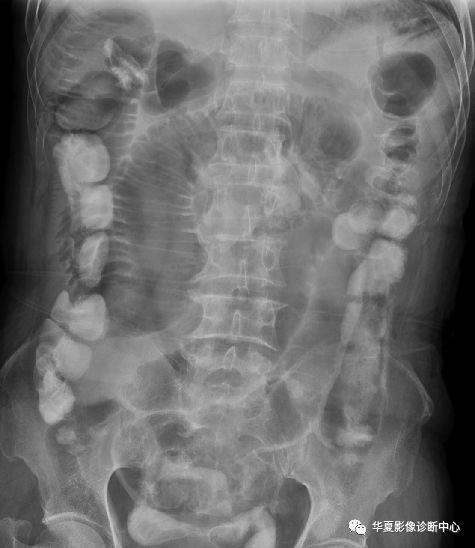 结肠梗阻结肠肠管扩张明显,升,降结肠区肠管内可见多个气液平面.