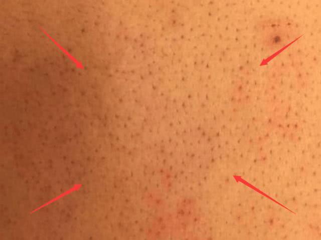 提醒:后背出现4个征兆,代表螨虫在"偷吃",并发症跟着来