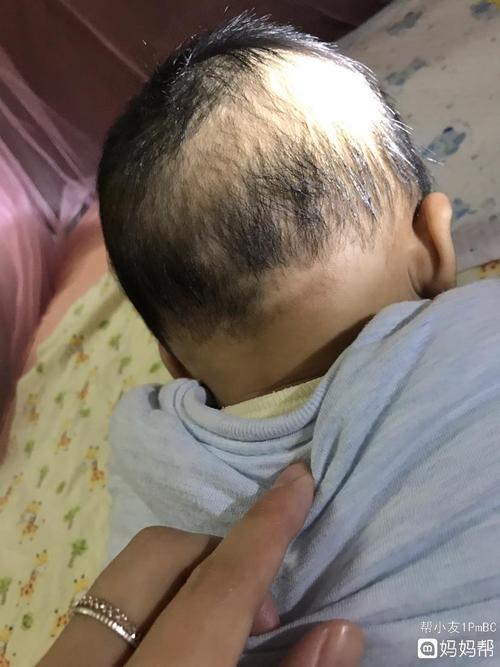 宝宝后脑勺接近脖子位置有块地方发白没头发