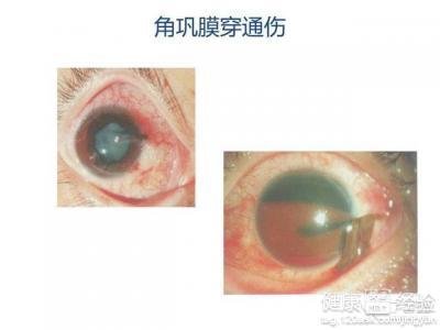 儿童眼外伤应怎样预防和处理
