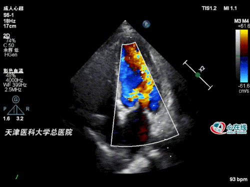 图2. 二尖瓣m型超声示前叶,后叶开放幅度减低,开放间距减小.