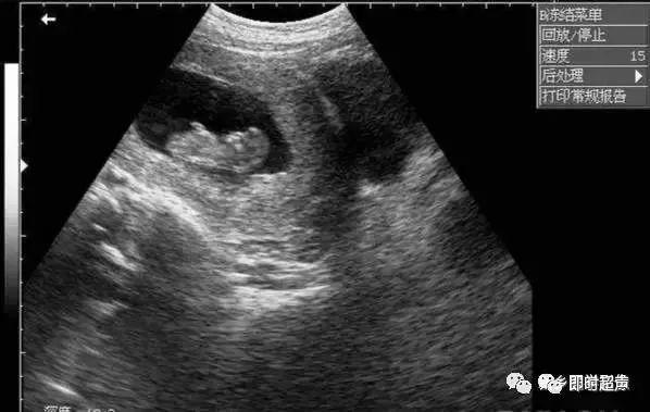 脑室率:在双顶径切面略向上平行移动的切面(测量侧脑室的标准平面),脑