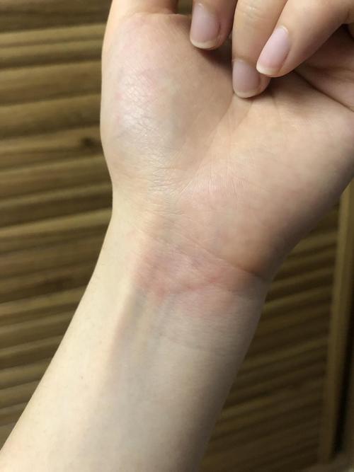 深夜求助 手上被玻璃划了没划伤却起了一个大水泡咋办