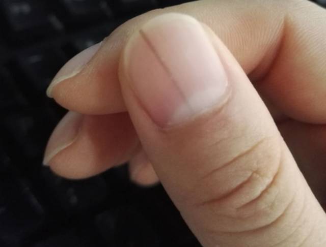 指甲上有这个黑线,马上去医院!这可能是致死率极高的癌症!