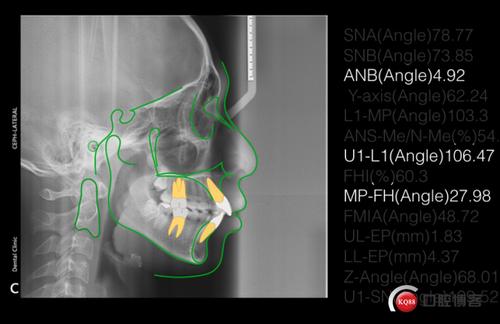 8个月拔牙矫正双颌前突