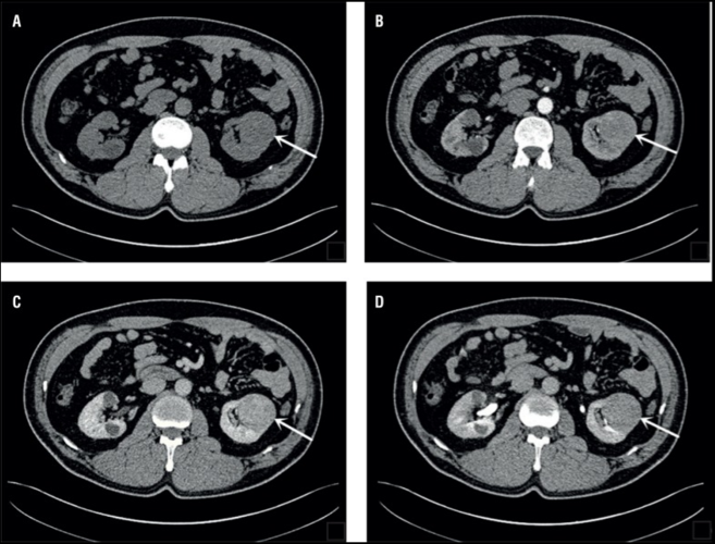 【病例】右肾嫌色细胞癌1例ct影像