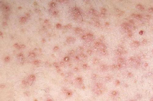 病种科普都过了青春期就别再把毛囊炎当青春痘了