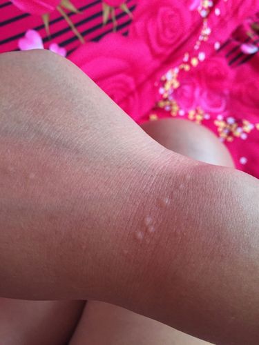 亲们,有长热毒的嘛?