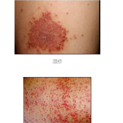【长春肤康皮肤】湿疹的七个误区