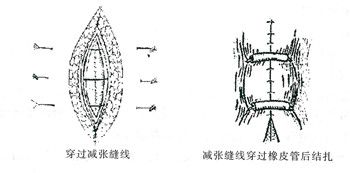常用的有下列缝合法:(1)垂直褥式内翻缝合法:又称lembet缝合,分间断与