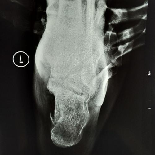 新沂市中医院骨一科微创切口治疗跟骨骨折