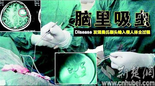 随州小伙脑内现寄生虫致身体萎缩 或因食用未熟蛙肉