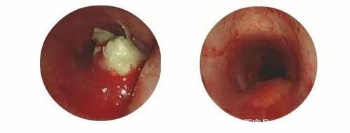 吞咽困难,警惕食管癌