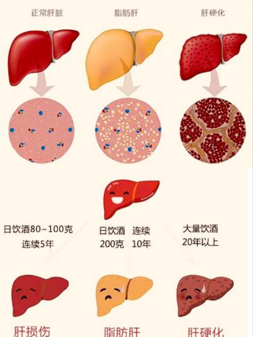 脂肪肝可不会挑肥拣瘦别心存侥幸