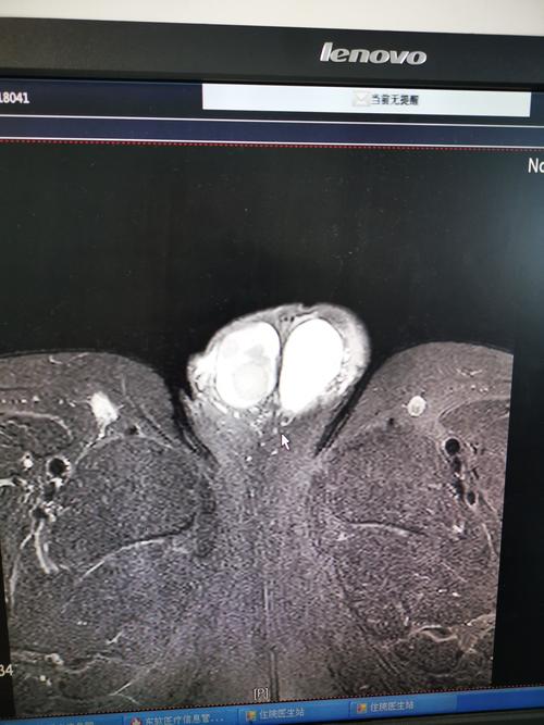 睾丸肿瘤切除术