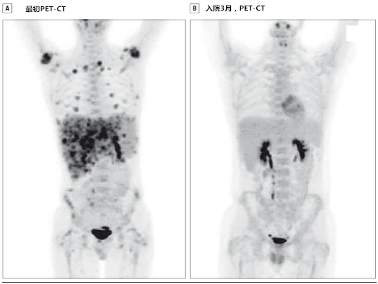 全身pet-ct
