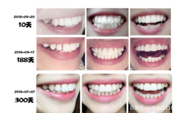 隐形牙齿矫正是什么有没有效果费用贵不贵