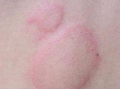 原创感染了艾滋病却还不知道?请留意皮肤上的小信号