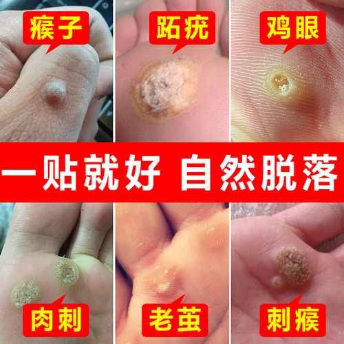 白云山鸡眼贴膏修正仁和同仁堂瘊子肉刺老茧去除跖疣