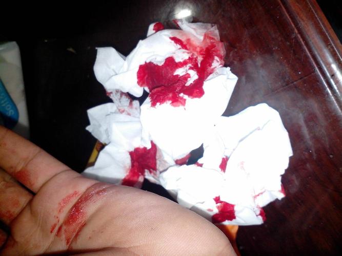 布满血渍的手和沾血的纸巾