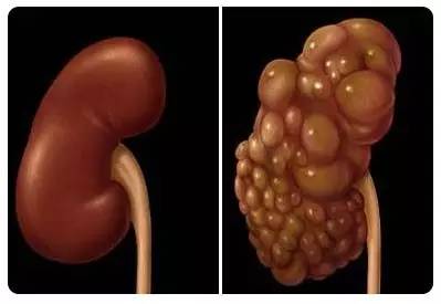 肾脏肿瘤或囊肿