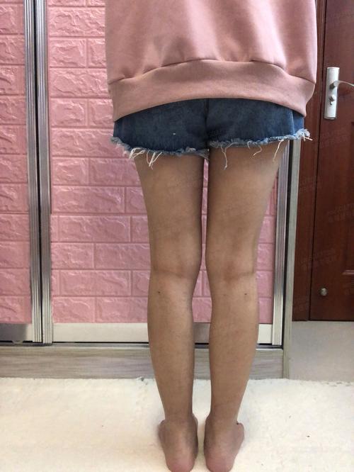 瘦小腿减肥吸脂瘦小腿项目分类美体塑形吸脂