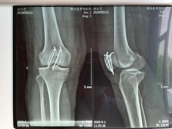 髌骨骨折