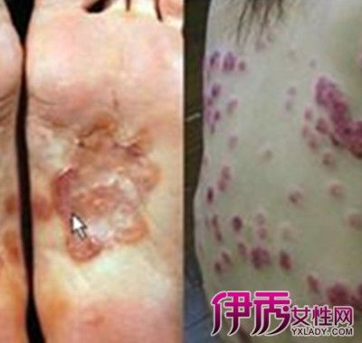 【图】女性硬下疳初期图片大曝光 小编告诉你常见症状