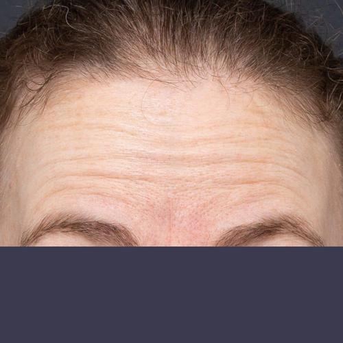 额头皱纹女性之前