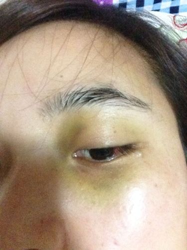 我的眼睛被打后,有淤青 ,请问:自己用什么方法可以去除?