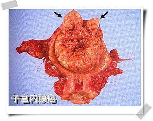 子宫内膜癌颗粒状癌组织图