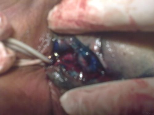 今天做的低位肛瘘,请大家欣赏