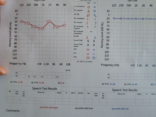 纯音测听 中耳分析:在耳鼻喉科进行更精确地听力测试,判断听力下降