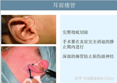 耳朵上隔壁有个小洞是天生就会这样的那个小洞有时还会流水出来臭臭的