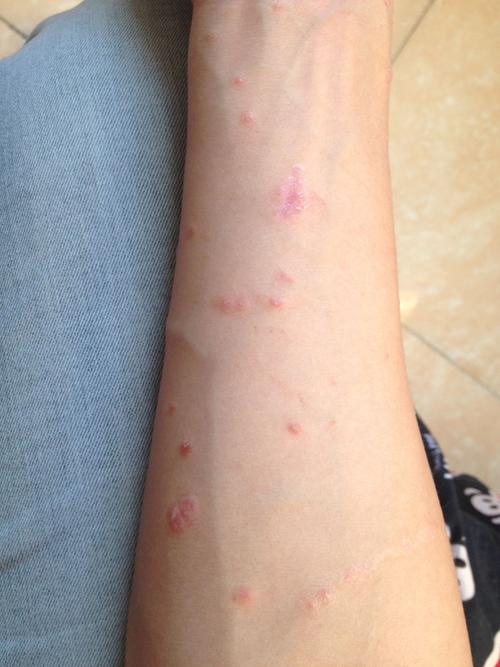 跟梅毒很像,四月做了血检,是阴性! 但是四月9