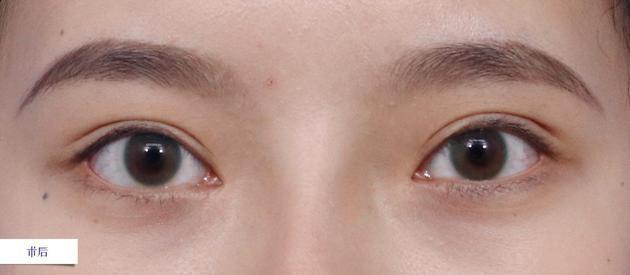 双眼皮的位置在哪儿大家都知道,那眼角具体的位置范围很多人可能都不