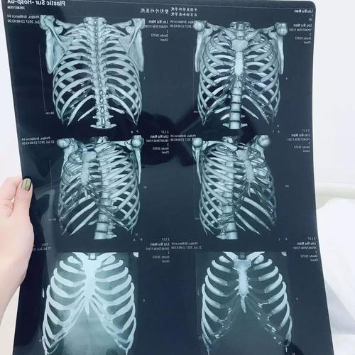 【脊柱健康】胸肋小关节错位与紊乱