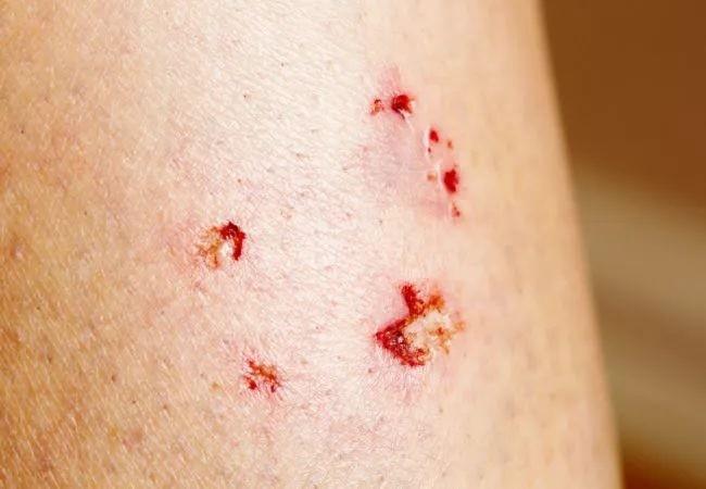 猫狗咬伤后伤口的处理:是关键!切记!