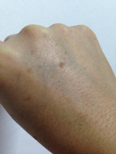 问:请问医生我这手上长的是什么东西,要怎么治.