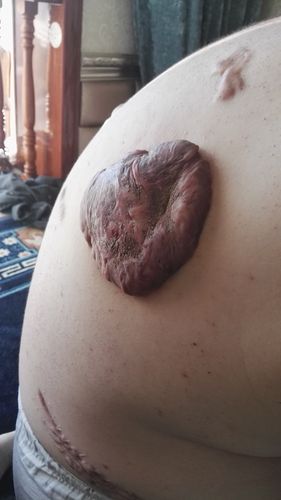 请问这种肉瘤有什么办法治疗吗?