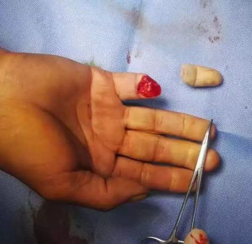 神奇断指居然复活重生了