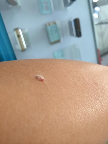 2014-03-19 石保磊 医师 我20岁,男,今年夏天胳膊上出了好像肉疙瘩一