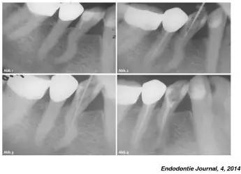 弯曲冠部的内侧牙本质和弯曲根尖部的外侧牙本质(如上图),造成侧穿