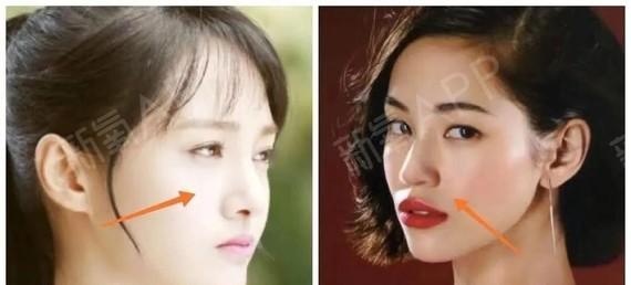 为什么越来越多人做鼻基底它的作用有多大