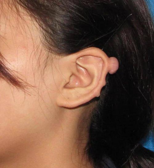 广东靓女打耳洞,竟长出瘢痕疙瘩!只能手术切除
