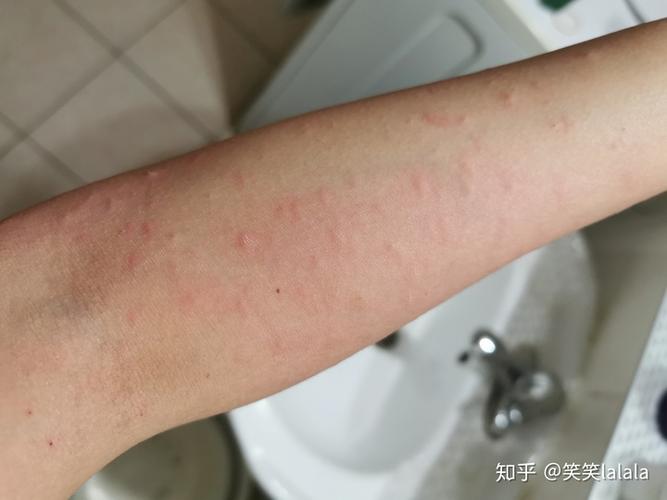 过敏湿疹荨麻疹的求医自救之路