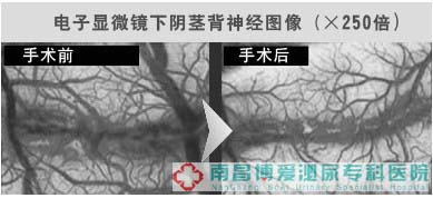 双微背神经阻断分离术 30分钟攻克原发性早泄