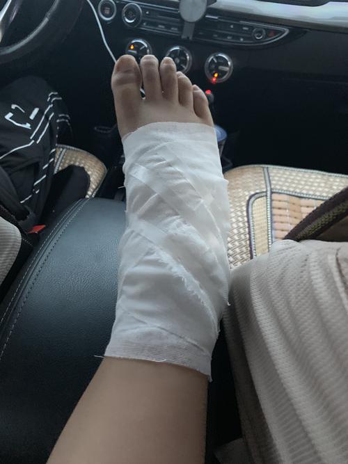 脚扭伤了 蔡卓城 10岁