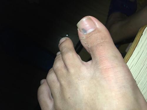 大拇指指甲发黑我这个是灰指甲吗