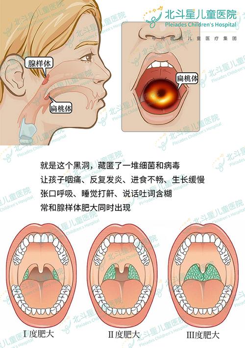 儿童扁桃体肥大腺样体肥大
